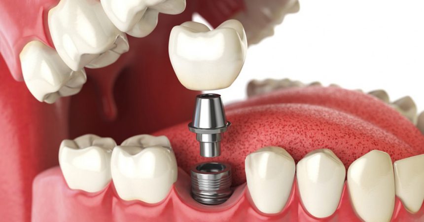 Implantologia dentale