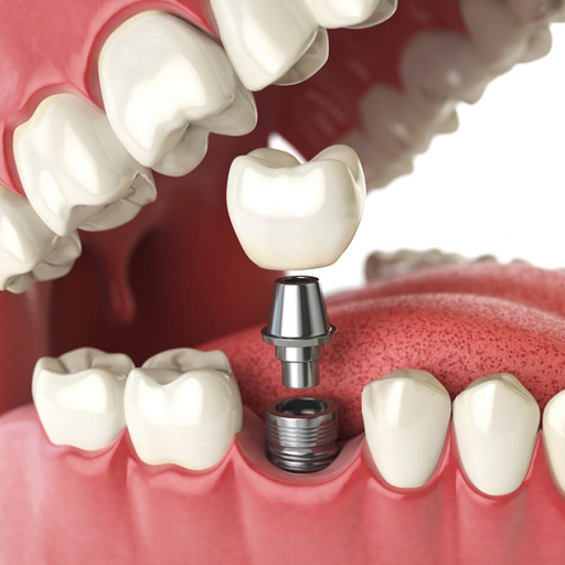 Implantologia dentale