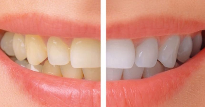 Sbiancamento dentale